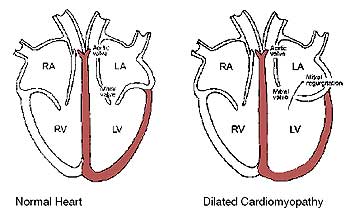 Dilated Cardiomyopathy Dilated Cardiomyopathy